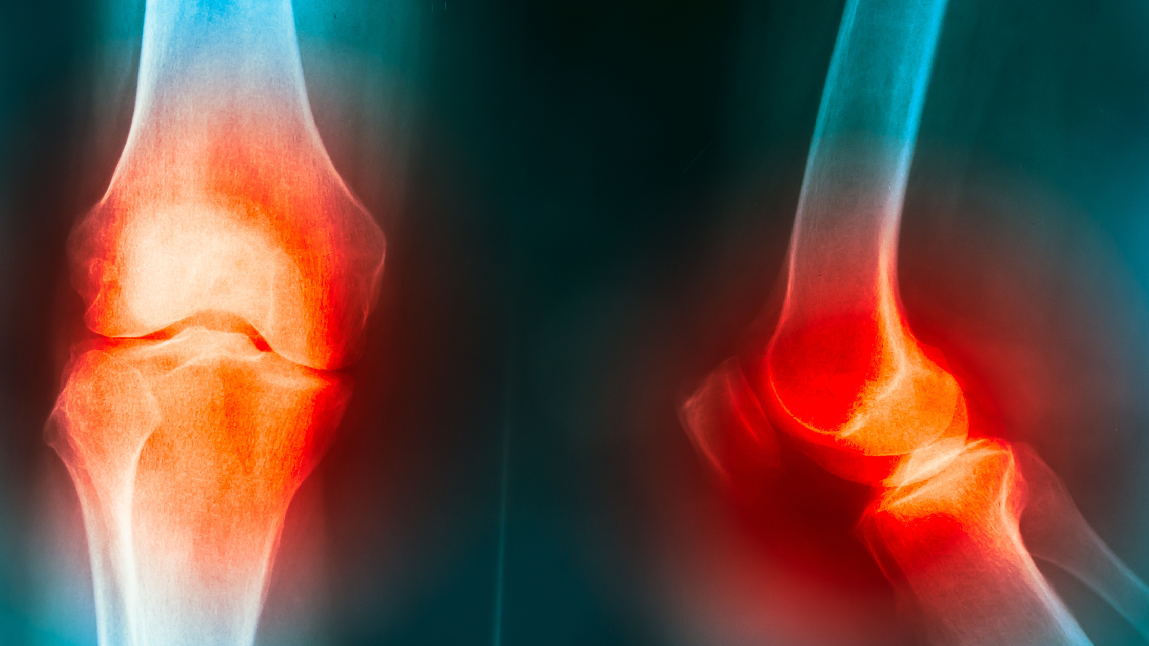joint pain in the knees