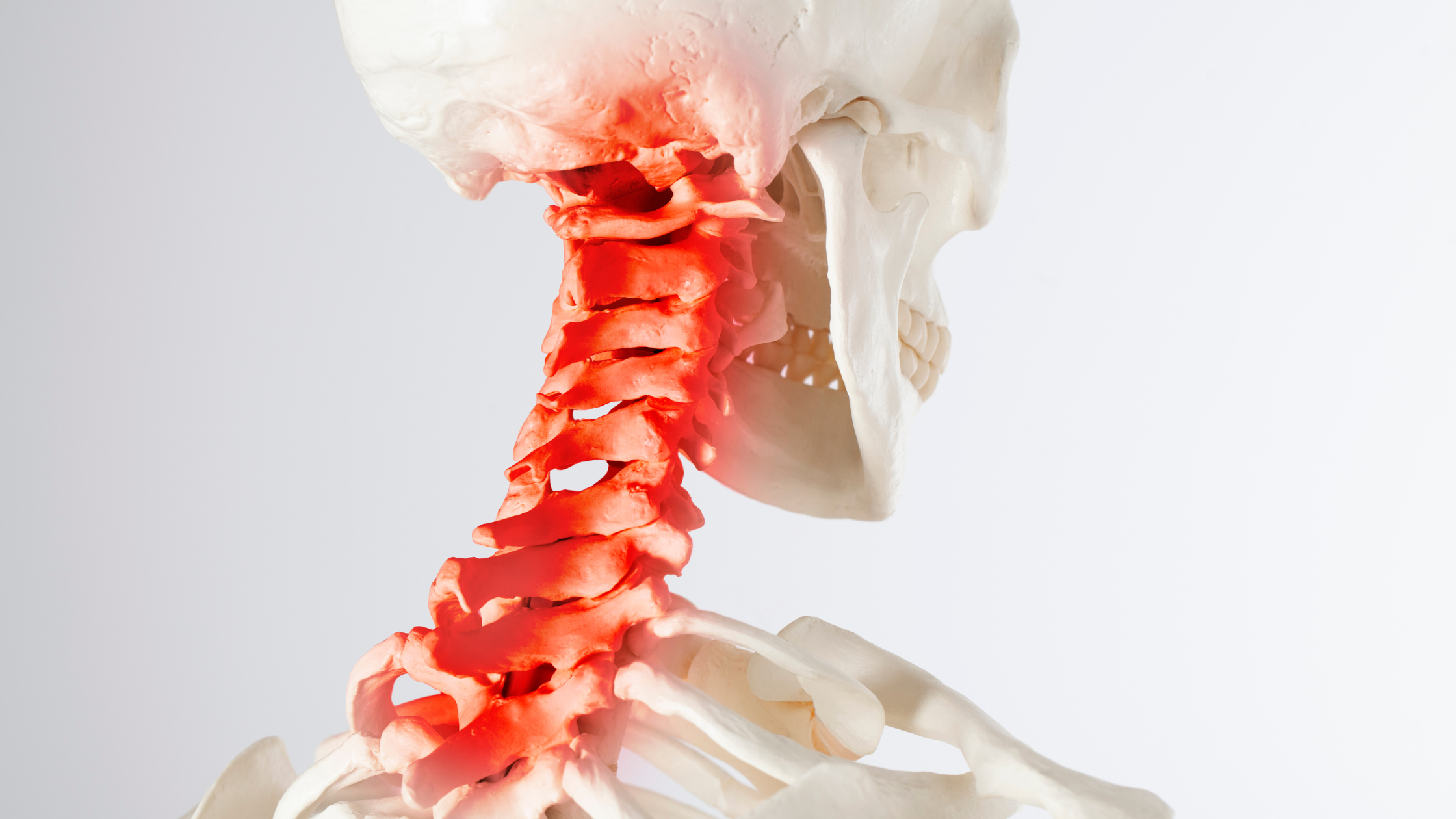 cervicogenic headaches